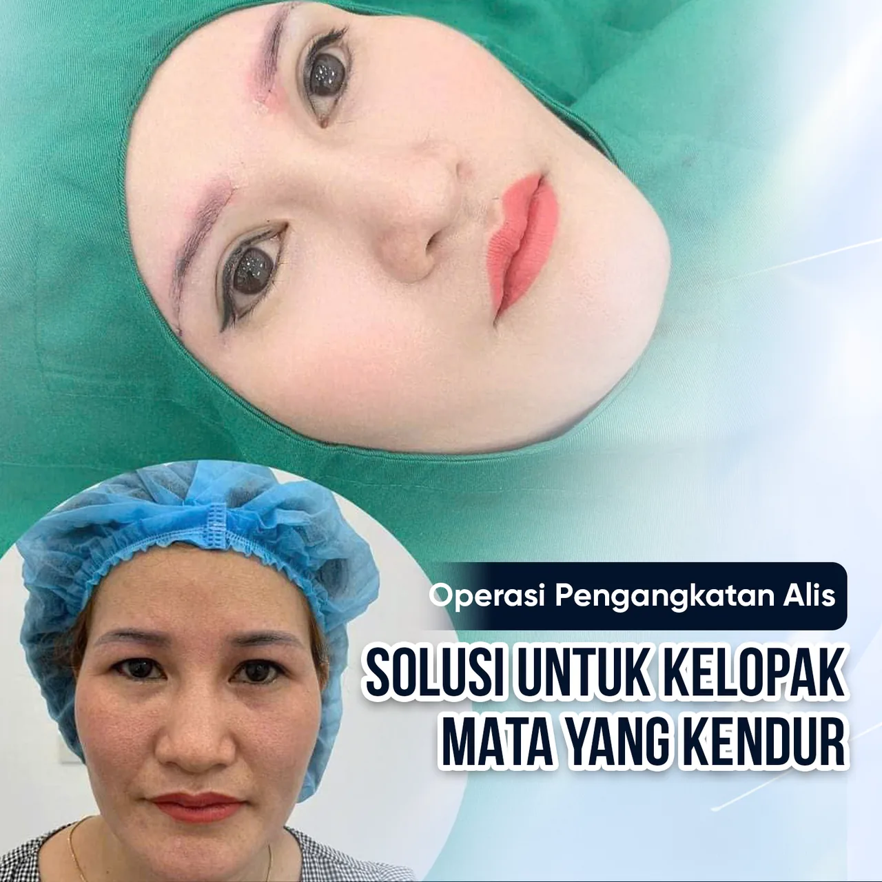 Ilustrasi Pengangkatan Alis – Rahasia Wajah Awet Muda bagian 6