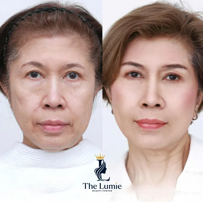 Ilustrasi Facelift 9D – Kunci Kulit Awet Muda bagian 1