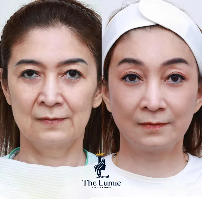 Ilustrasi Facelift 9D – Kunci Kulit Awet Muda bagian 3