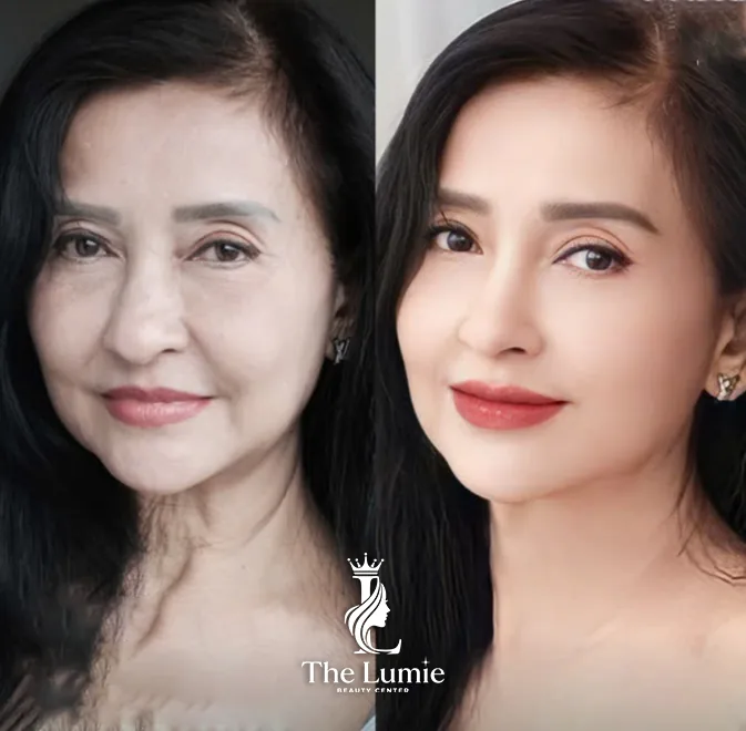 Ilustrasi Facelift 9D – Kunci Kulit Awet Muda bagian 5