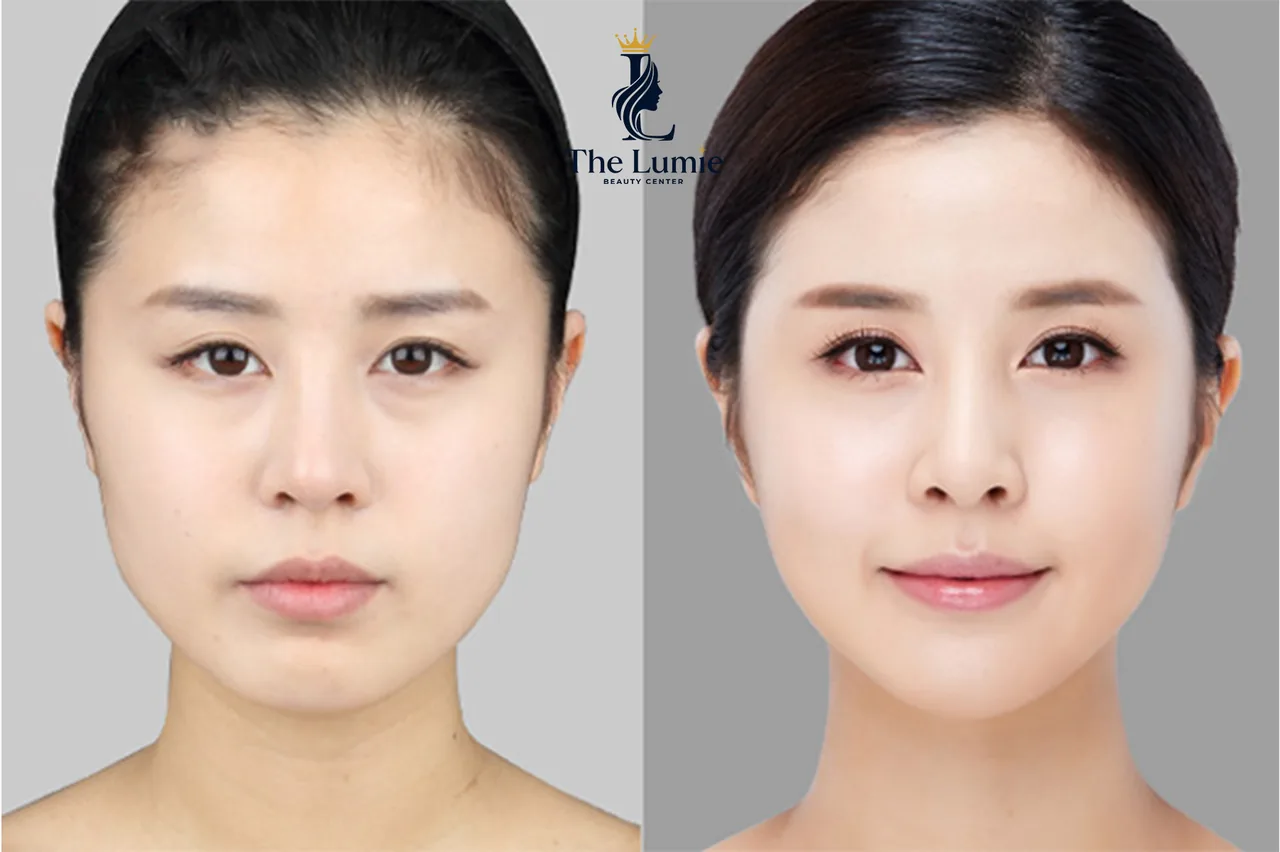 Ilustrasi Implan Dagu – Rahasia Wajah V-Line yang Anggun bagian 4