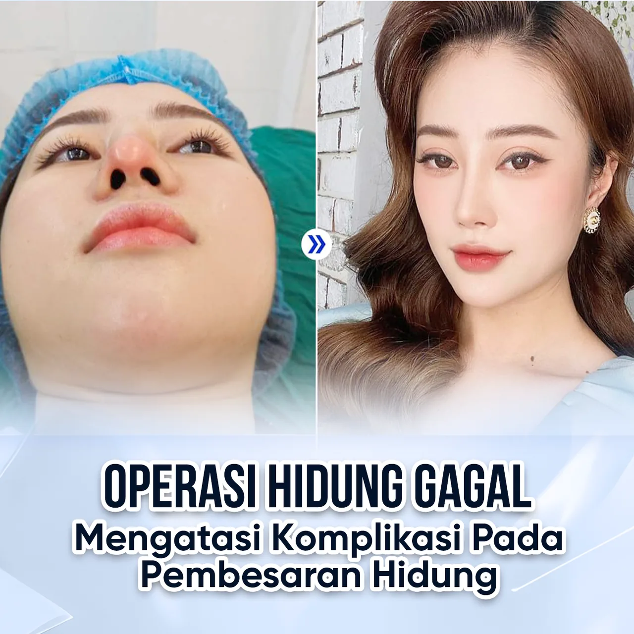 Ilustrasi Pembentukan Hidung Estetika – Panduan Rhinoplasty bagian 5