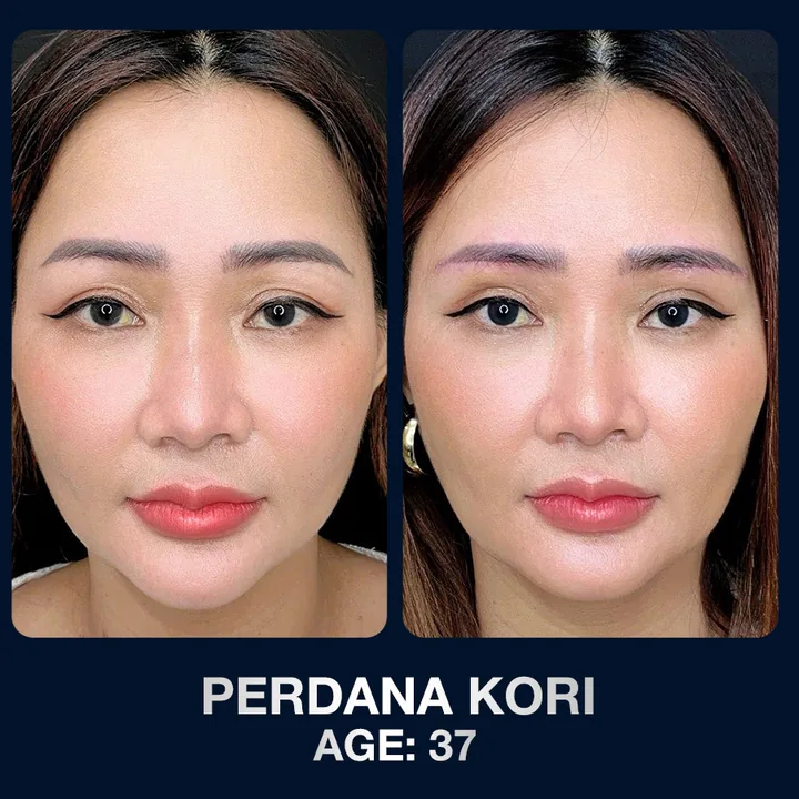 Hasil sebelum dan sesudah brow lift di The Lumie Beauty Center