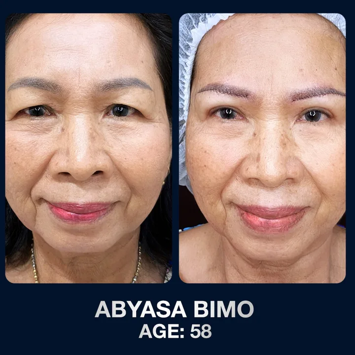 Hasil sebelum dan sesudah brow lift di The Lumie Beauty Center