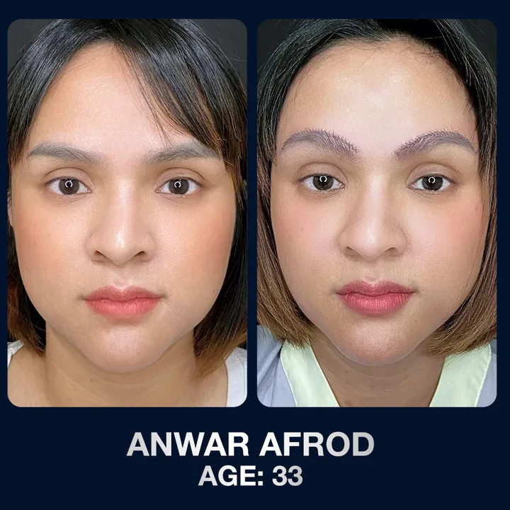 Hasil sebelum dan sesudah brow lift di The Lumie Beauty Center