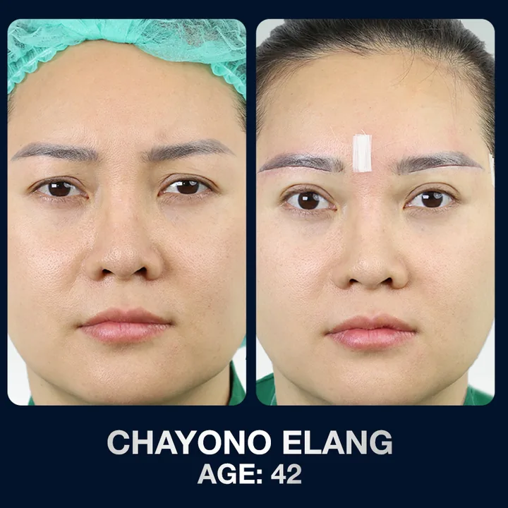 Hasil sebelum dan sesudah brow lift di The Lumie Beauty Center