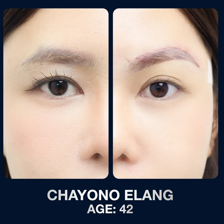 Hasil sebelum dan sesudah brow lift di The Lumie Beauty Center