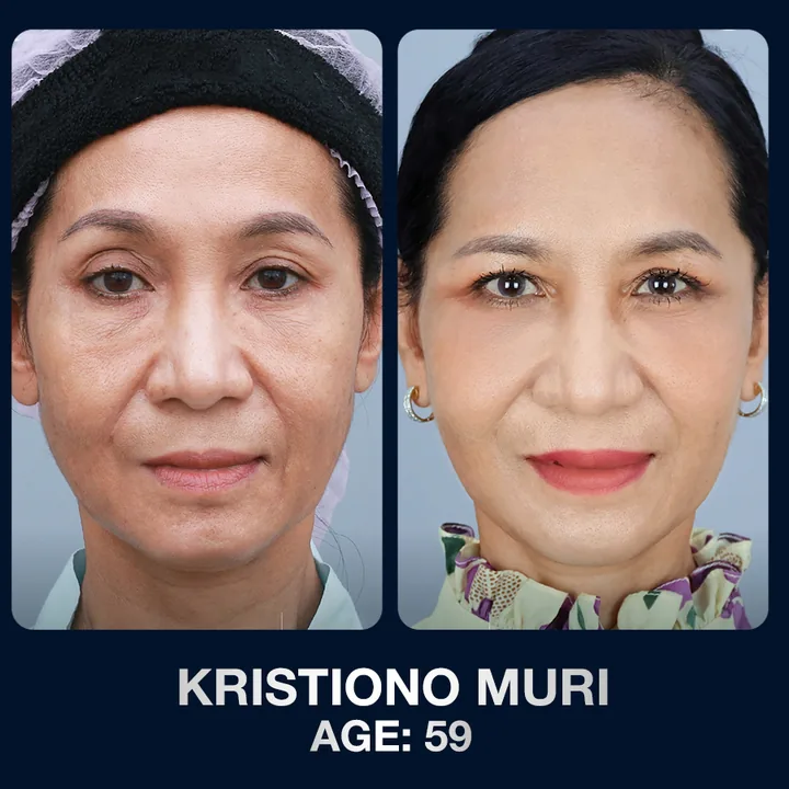 Hasil sebelum dan sesudah pengencangan wajah di The Lumie Beauty Center