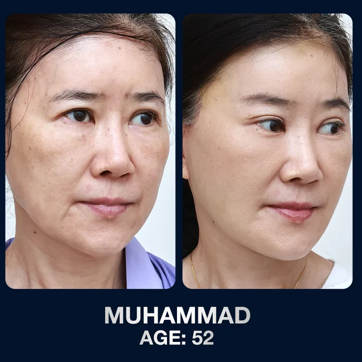 Hasil sebelum dan sesudah pengencangan wajah di The Lumie Beauty Center