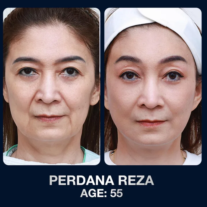 Hasil sebelum dan sesudah pengencangan wajah di The Lumie Beauty Center