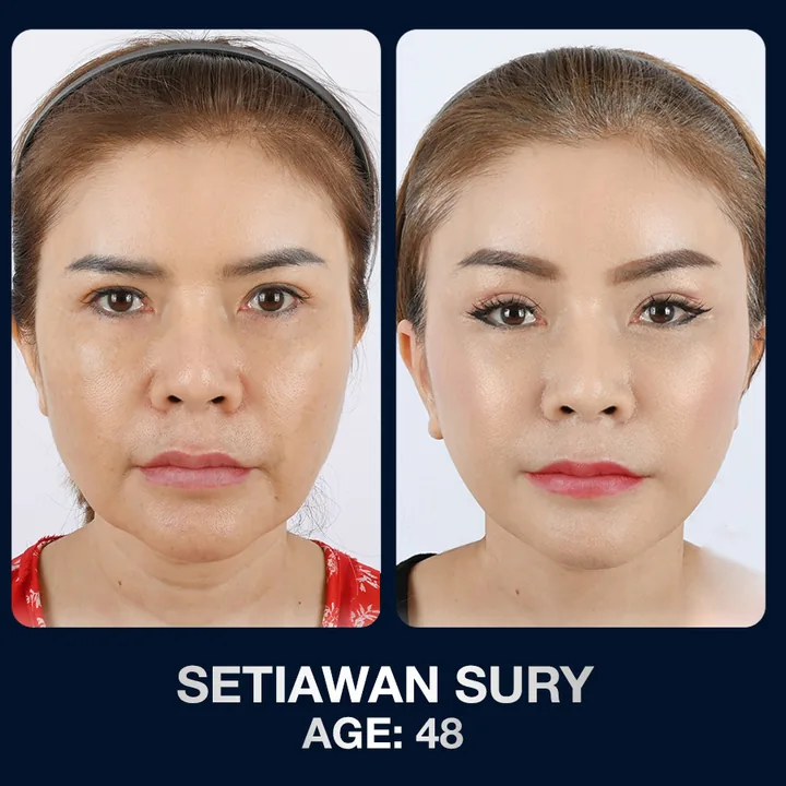 Hasil sebelum dan sesudah pengencangan wajah di The Lumie Beauty Center