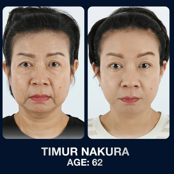 Hasil sebelum dan sesudah pengencangan wajah di The Lumie Beauty Center