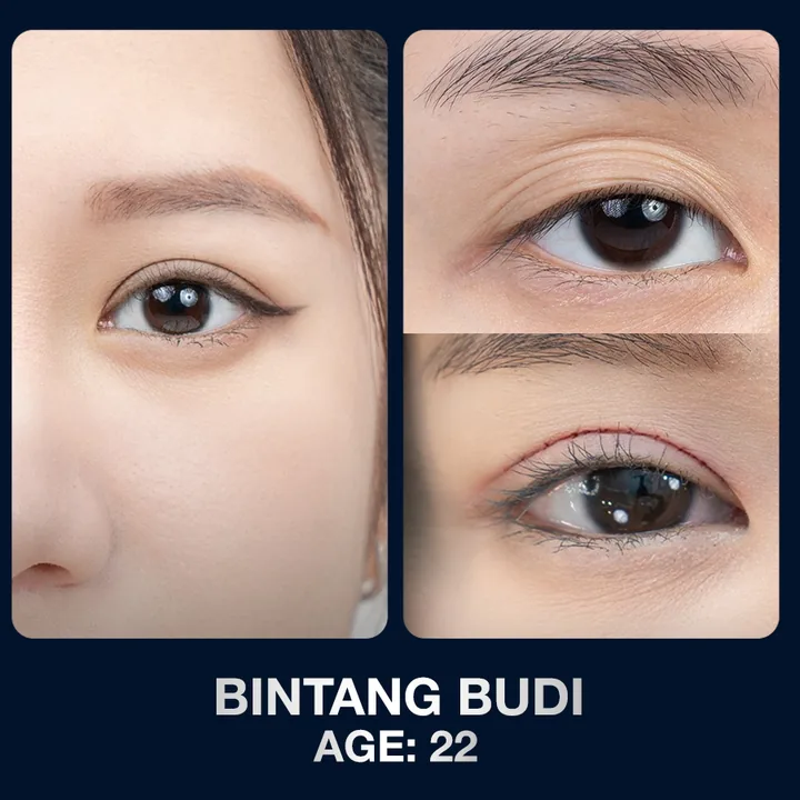 Hasil sebelum dan sesudah kelopak mata di The Lumie Beauty Center