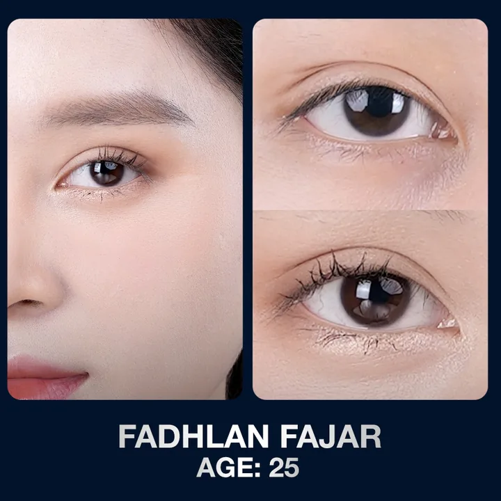 Hasil sebelum dan sesudah kelopak mata di The Lumie Beauty Center