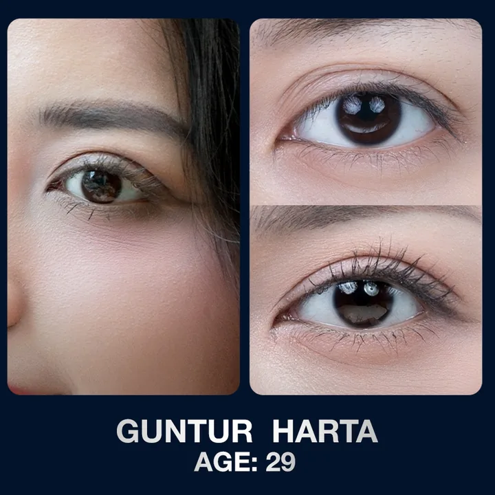 Hasil sebelum dan sesudah kelopak mata di The Lumie Beauty Center