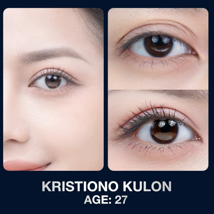 Hasil sebelum dan sesudah kelopak mata di The Lumie Beauty Center