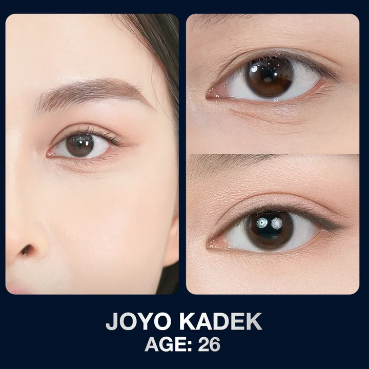 Hasil sebelum dan sesudah kelopak mata di The Lumie Beauty Center