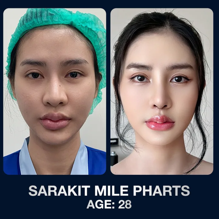 Hasil sebelum dan sesudah operasi hidung di The Lumie Beauty Center