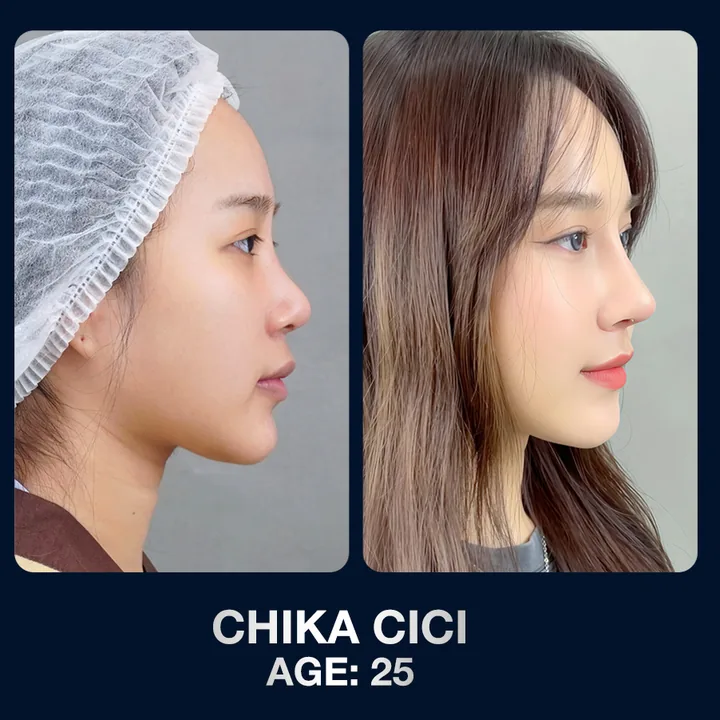 Hasil sebelum dan sesudah operasi hidung di The Lumie Beauty Center