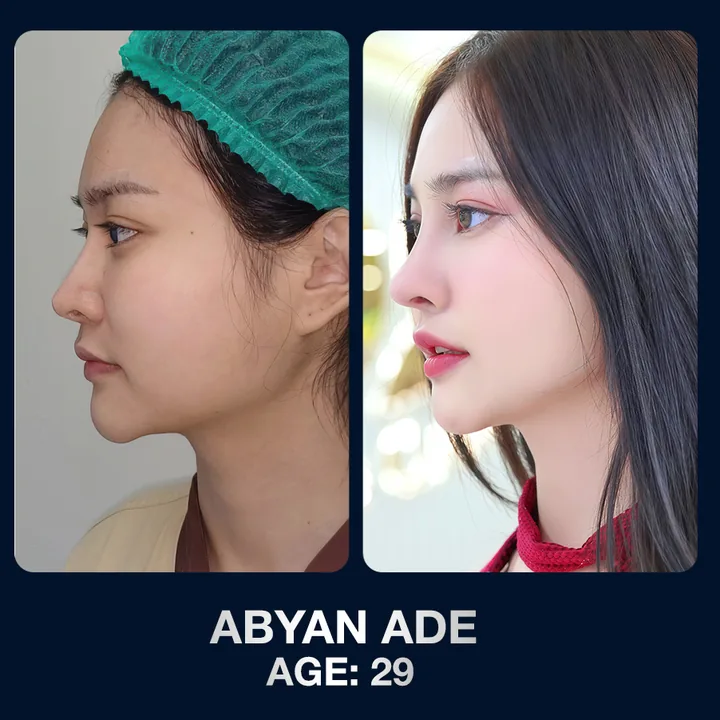 Hasil sebelum dan sesudah operasi hidung di The Lumie Beauty Center