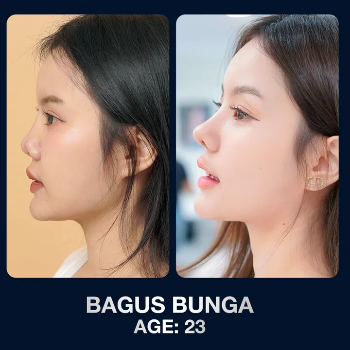 Hasil sebelum dan sesudah operasi hidung di The Lumie Beauty Center