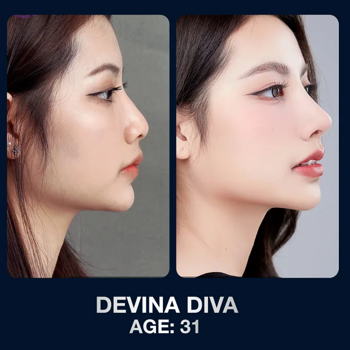 Hasil sebelum dan sesudah operasi hidung di The Lumie Beauty Center
