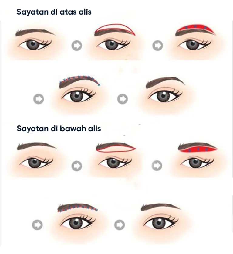 Ilustrasi Pengangkatan Alis – Rahasia Wajah Awet Muda dari The Lumie Beauty Center
